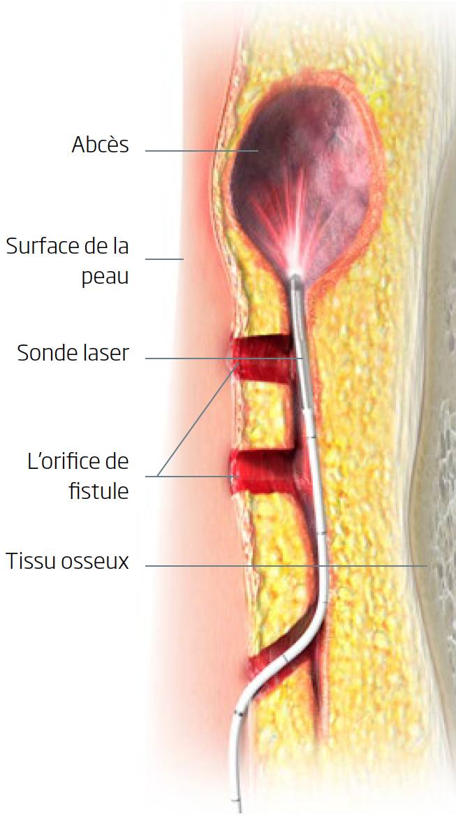 découvrez comment traiter efficacement un kyste lors de votre rénovation à paris grâce à nos conseils professionnels et solutions adaptées.