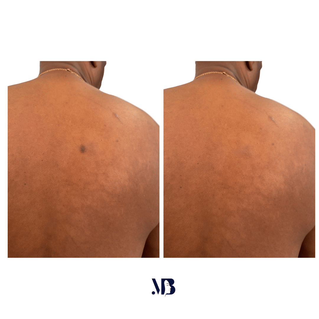 découvrez comment traiter efficacement un kyste avec nos conseils professionnels de rénovation à paris pour un résultat sûr et durable.